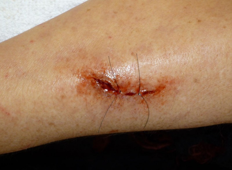 Points suture.jpg